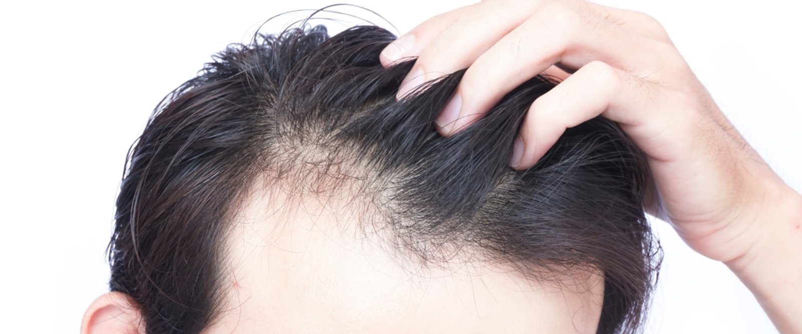 Is hair loss from not eating permanent?