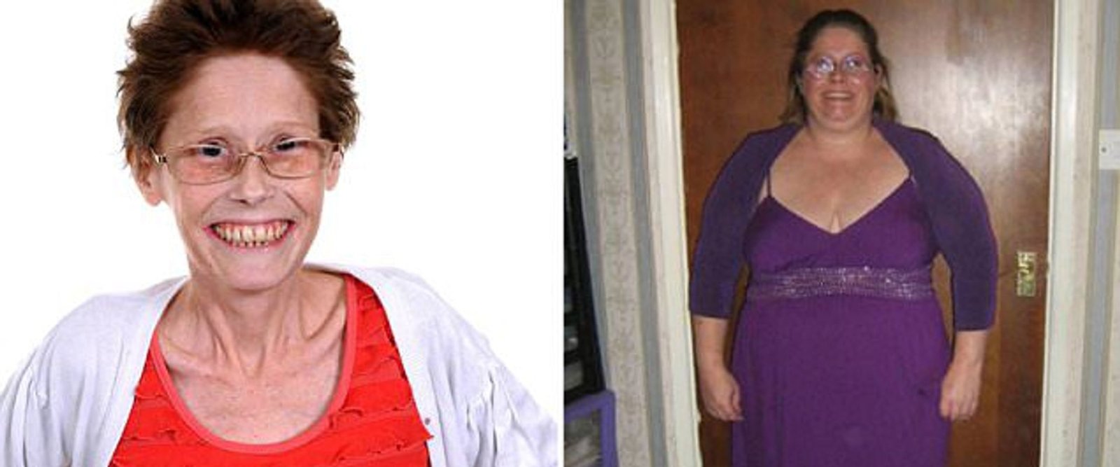 What are the signs of malnutrition after bariatric surgery?