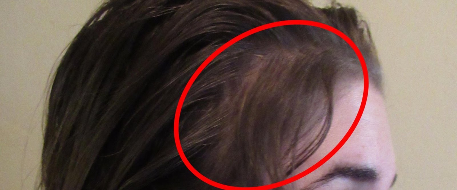 Does gastric sleeve surgery cause your hair to fall out?