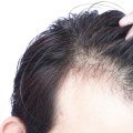 Is hair loss due to diet reversible?