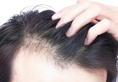 How do I know if hair loss is permanent?