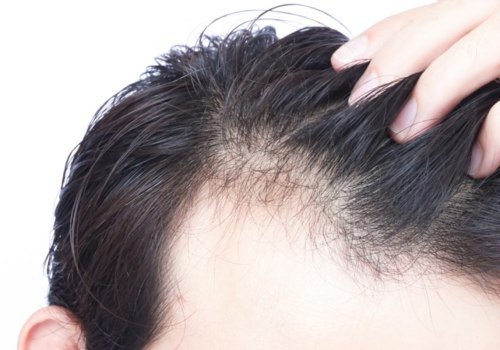 Is diet-related hair loss permanent